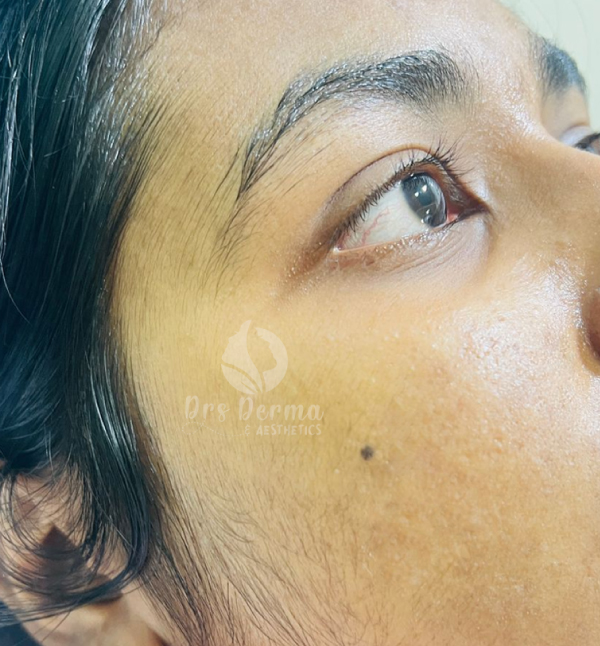 Active Acne Treatment - After