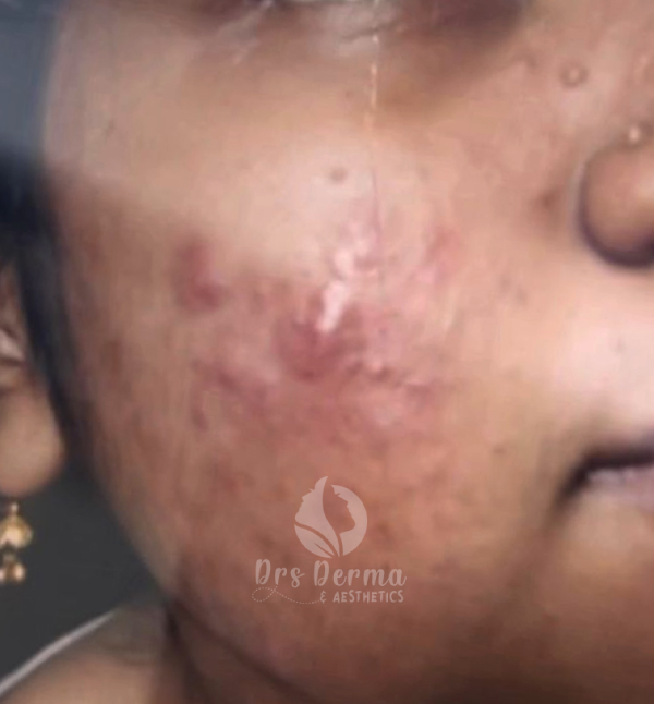 Active Acne Treatment - Before