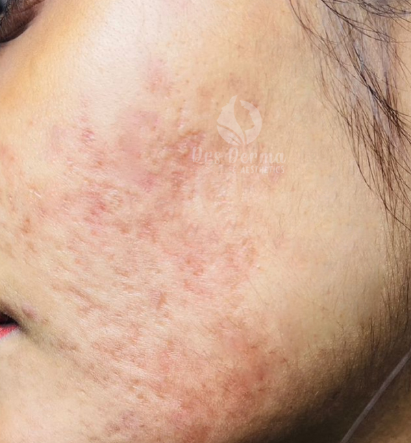 Active Acne Treatment II - After