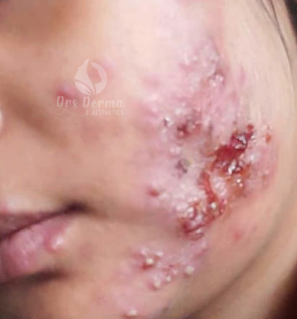 Active Acne Treatment II - Before