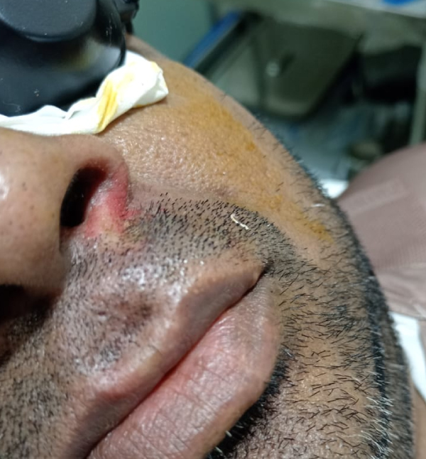 Pyogenic Granuloma Removal - After