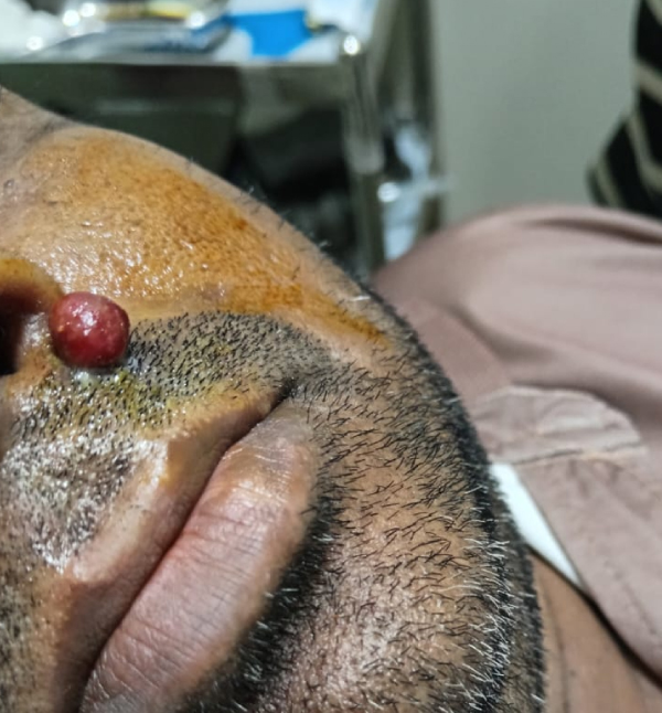 Pyogenic Granuloma Removal - Before