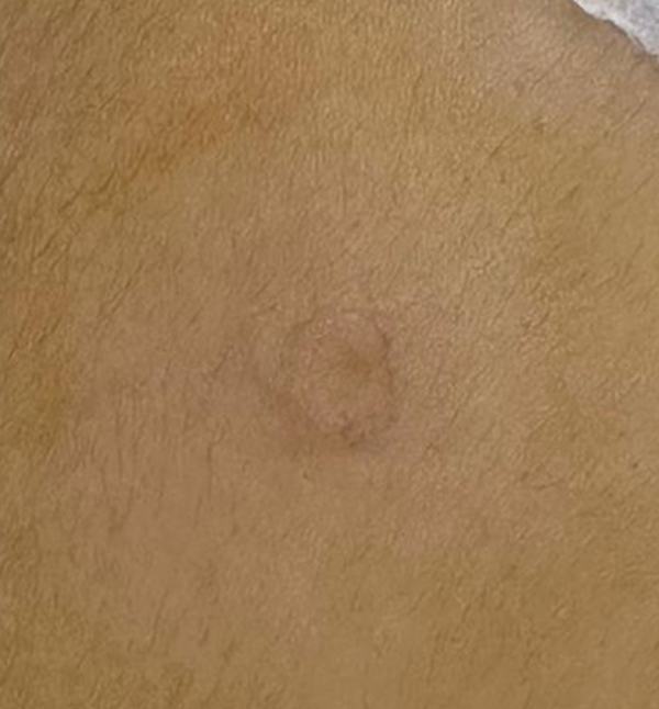 Wart Removal - After