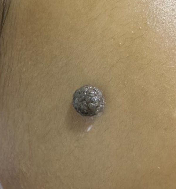Wart Removal - Before
