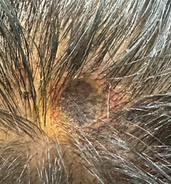 Mole Removal - After
