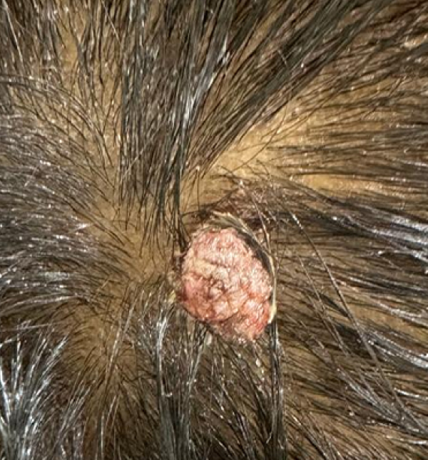 Mole Removal - Before
